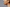 Skin Pigmentation: Why It Happens & How to Treat It Effectively