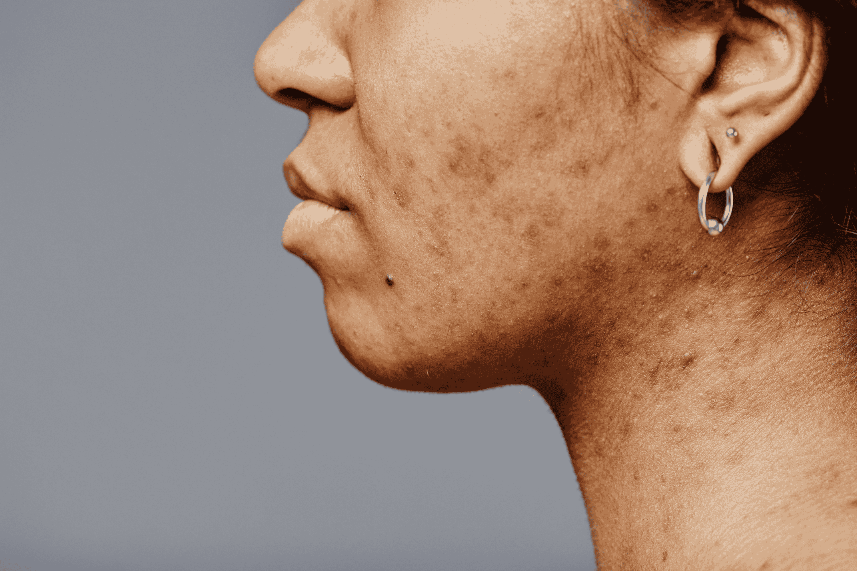 Skin Pigmentation: Why It Happens & How to Treat It Effectively
